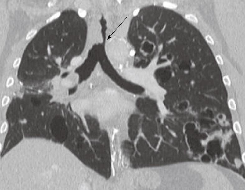 tracheal papilloma ct)