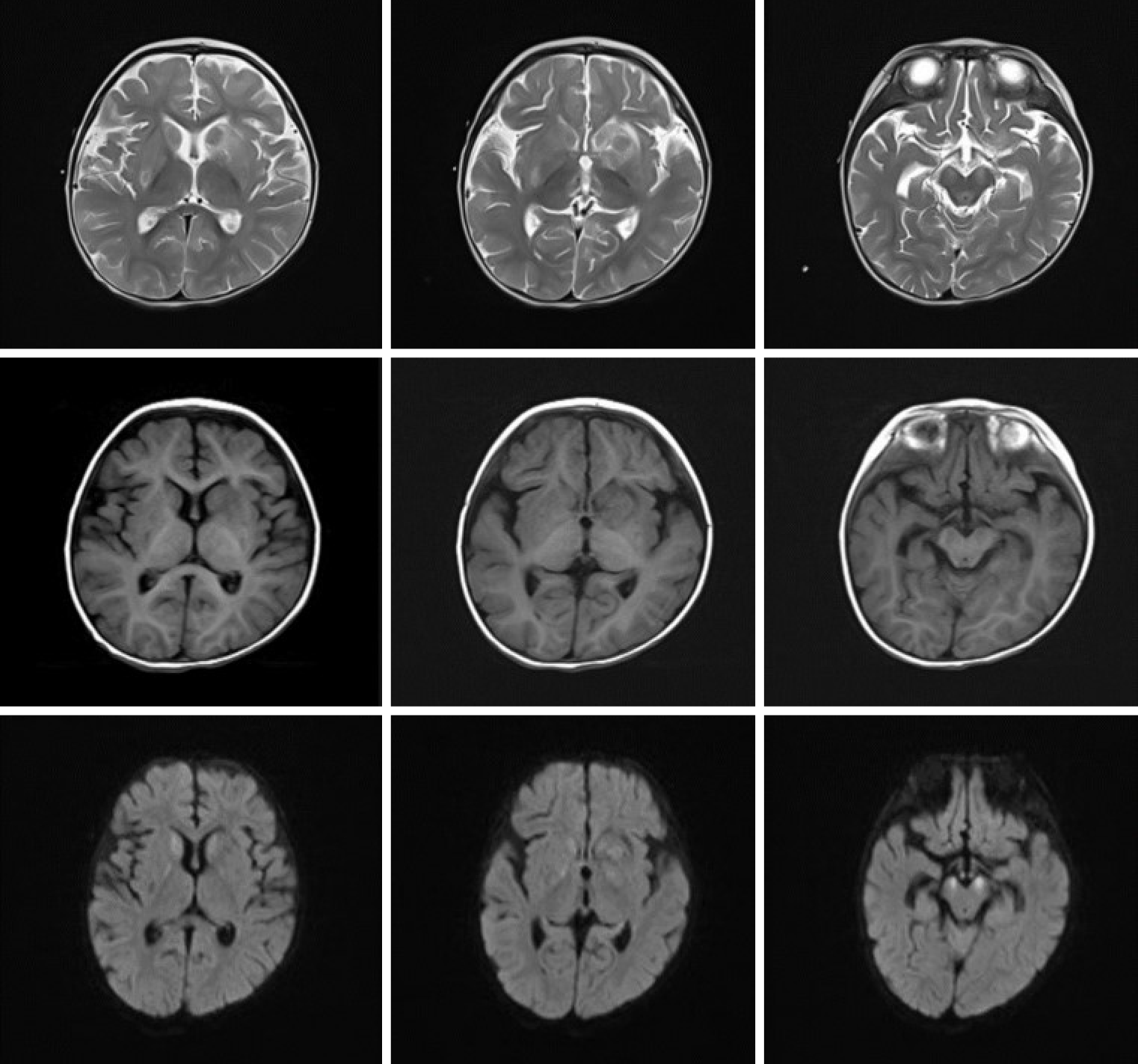 Emergence of lesions outside of the basal ganglia and irreversible ...