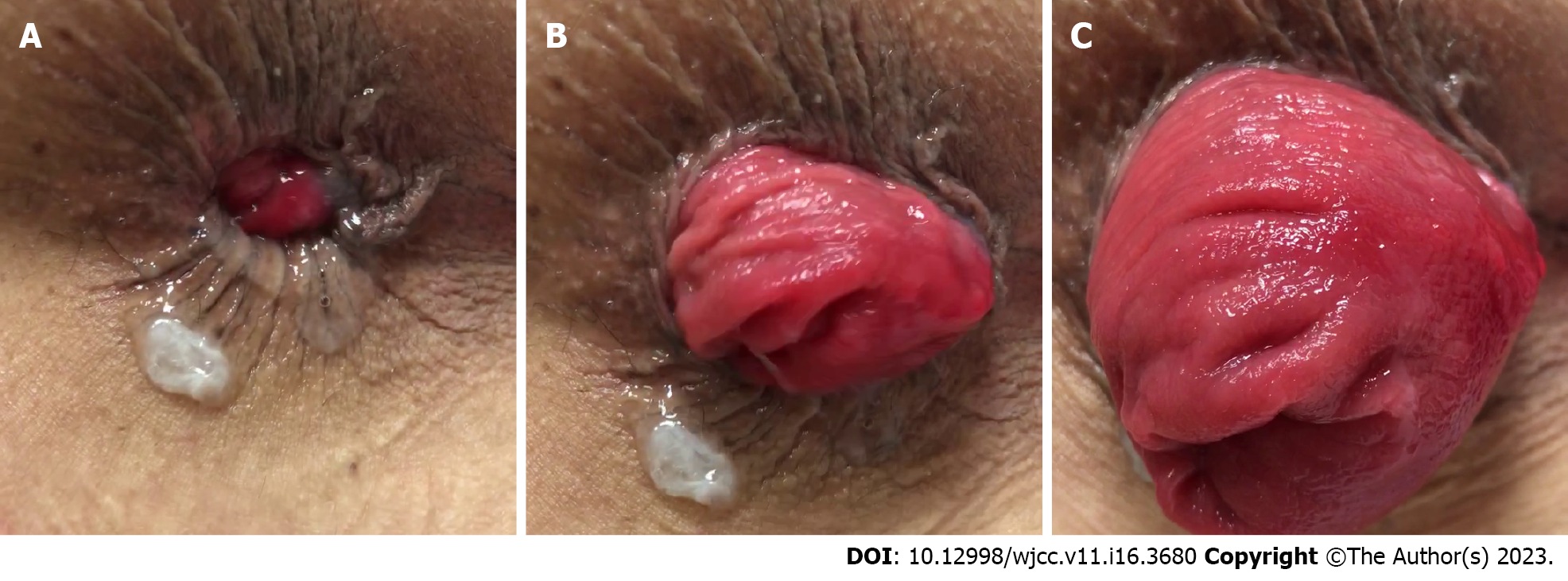 Current diagnostic tools and treatment modalities for rectal prolapse