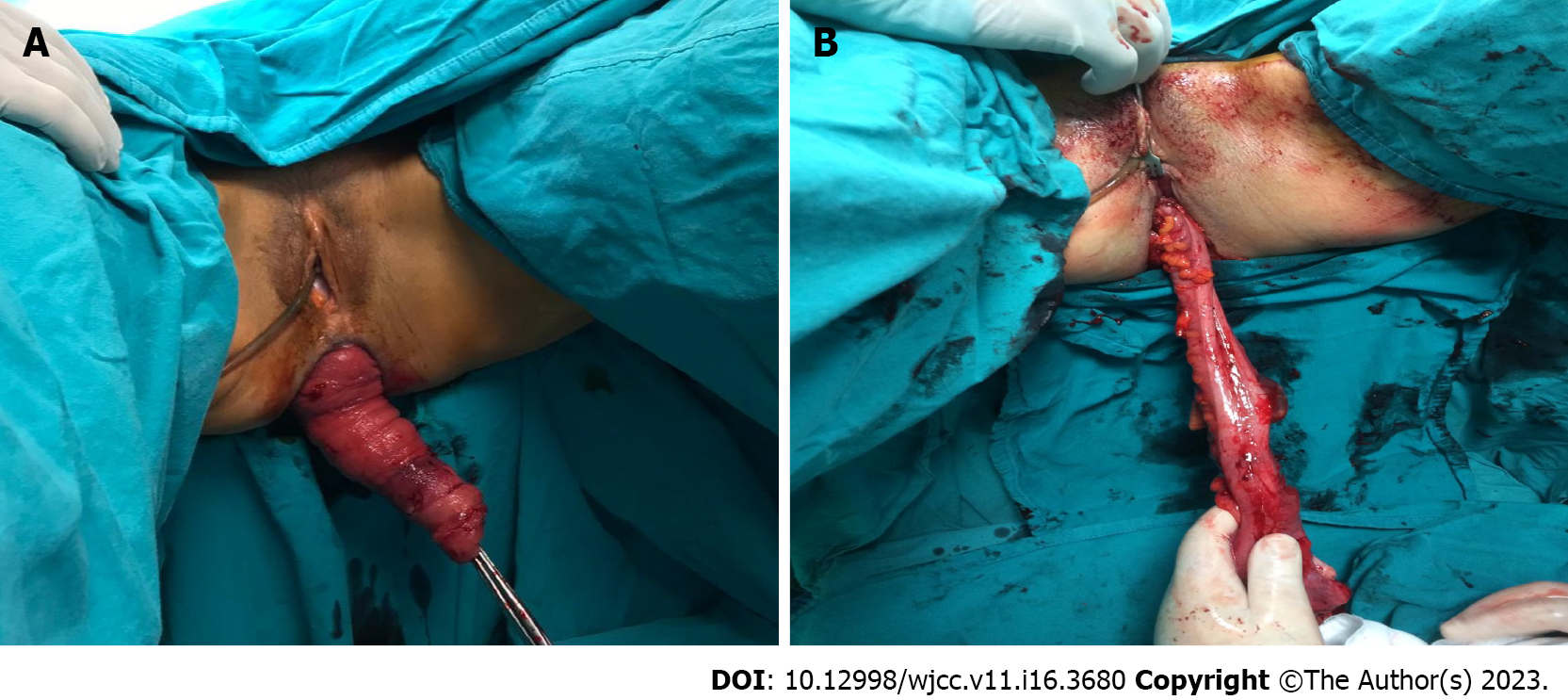 Current diagnostic tools and treatment modalities for rectal prolapse