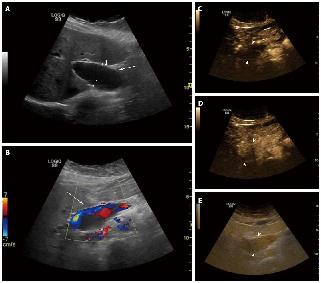 Contrast-enhanced ultrasound in portal venous system aneurysms: A multi ...