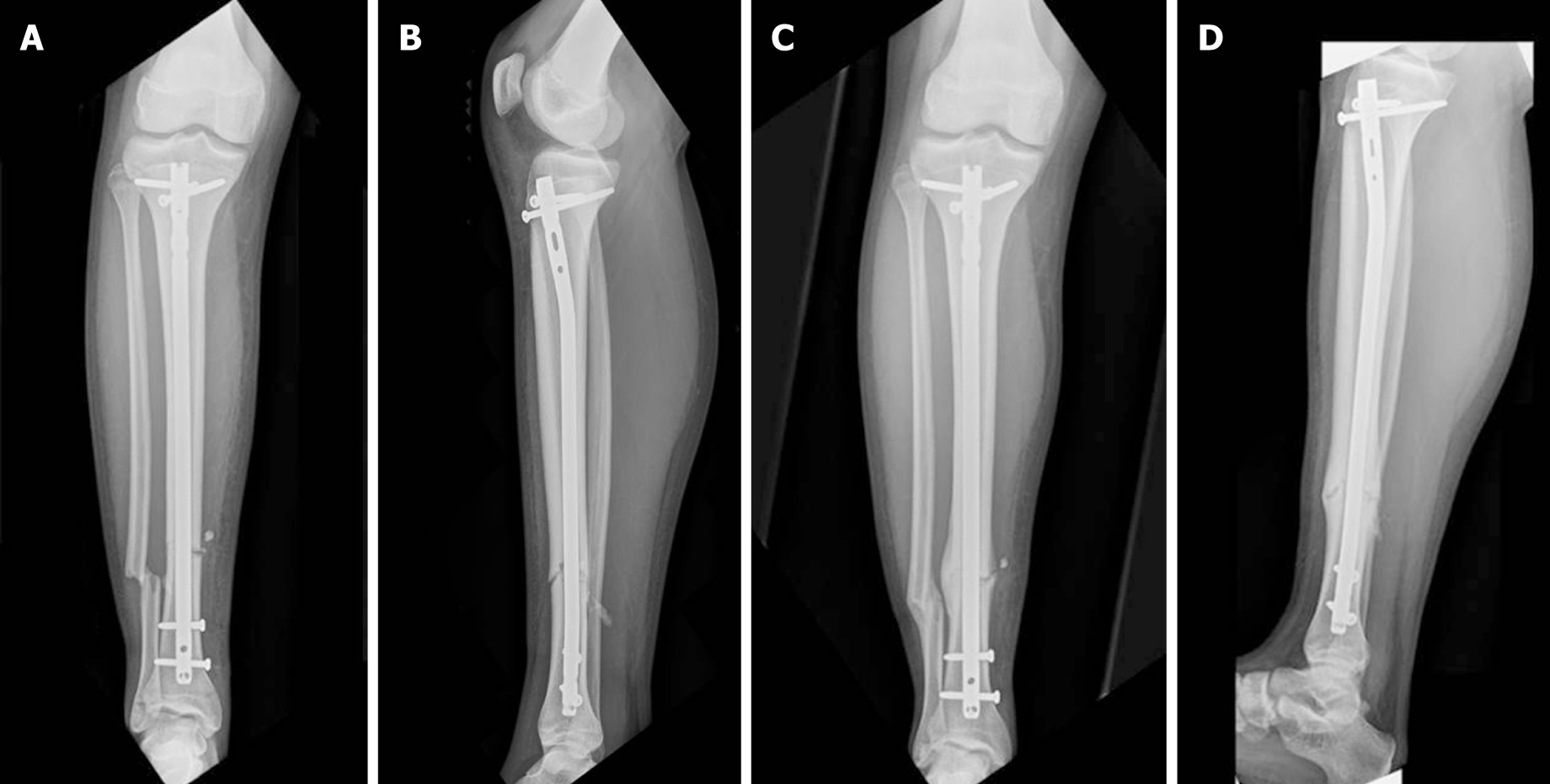 Rigid locked nail fixation for pediatric tibia fractures - Where are the  data?