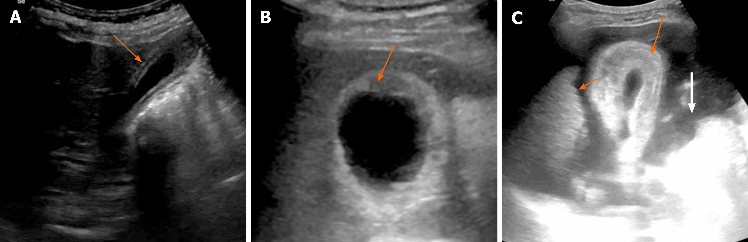 Gallbladder Wall Cyst Ultrasound