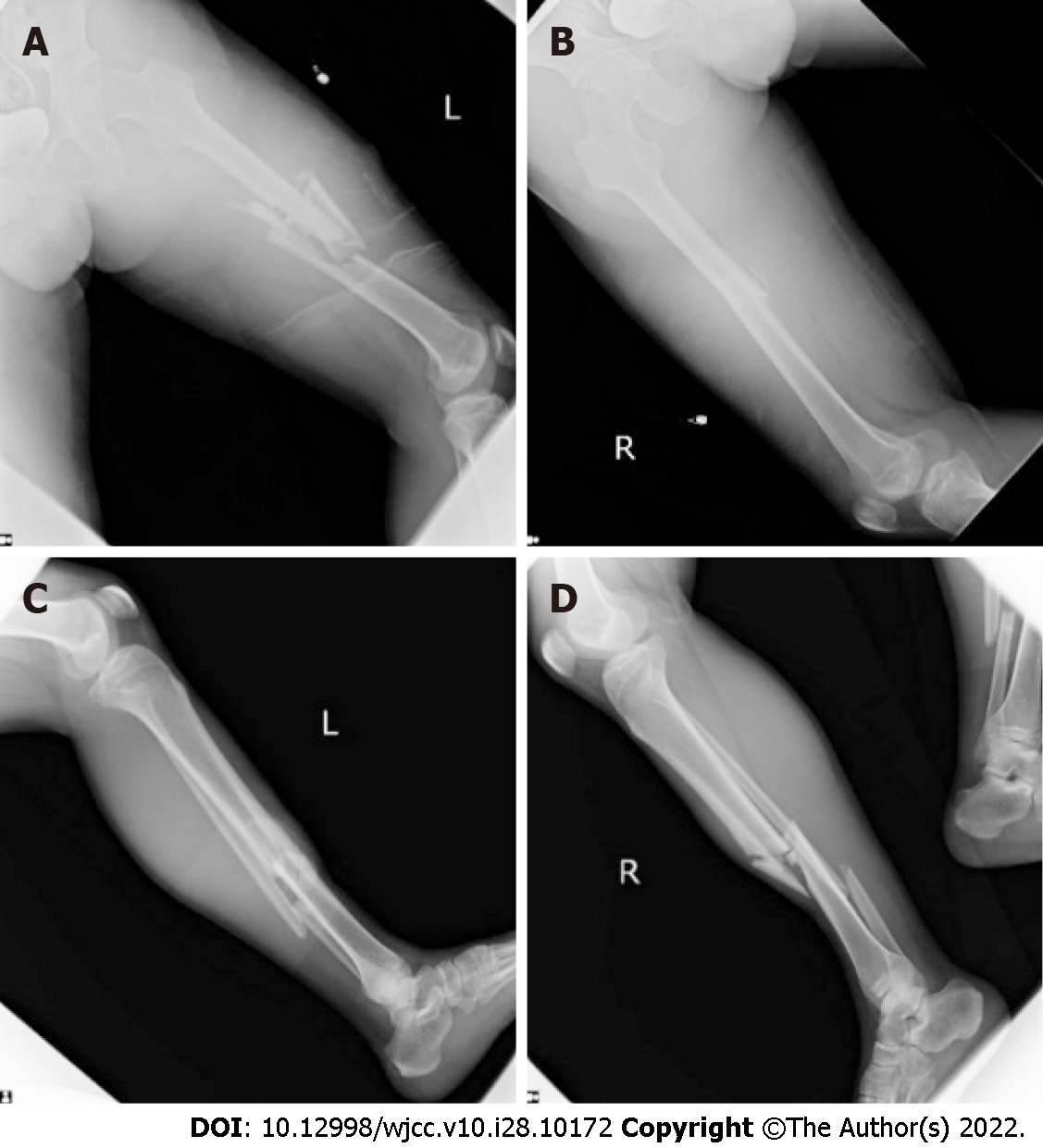 a) A 40 year old male with infected non-union left tibia type IIc of