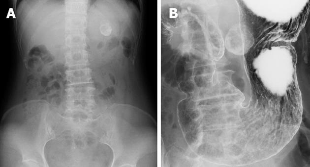 Gastrointestinal stromal tumor presenting with prominent calcification