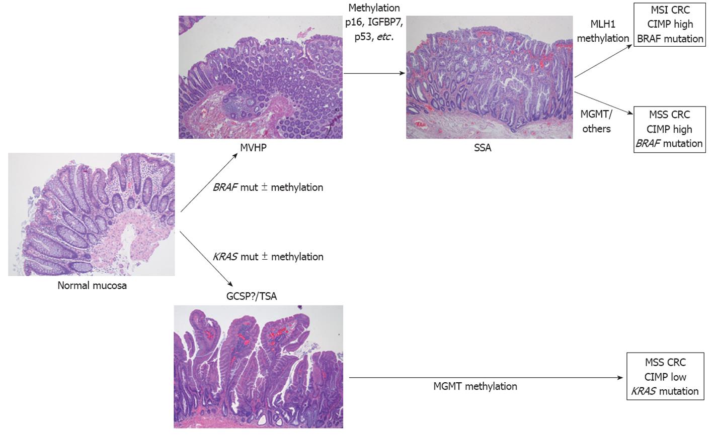 serrated-polyposis-syndrome-molecular-pathological-and-clinical-aspects