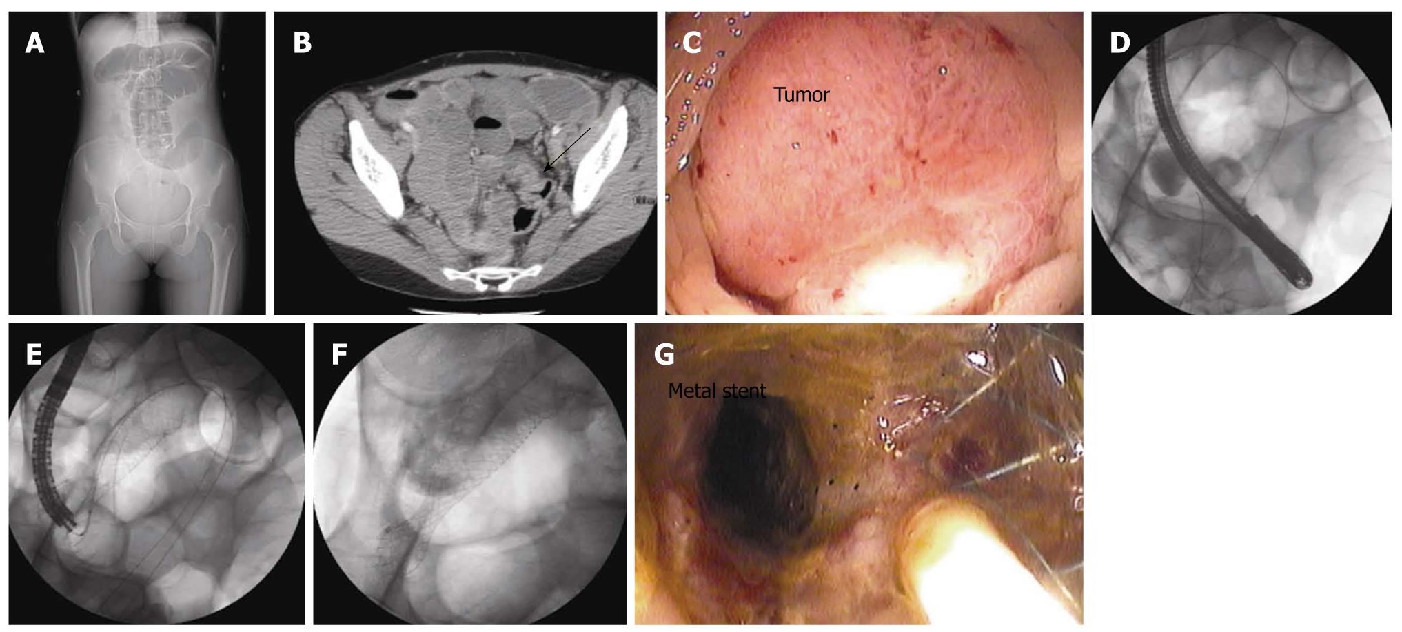 Management of stage IV rectal cancer Palliative options