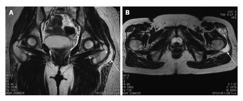 Cystic lesion around the hip joint