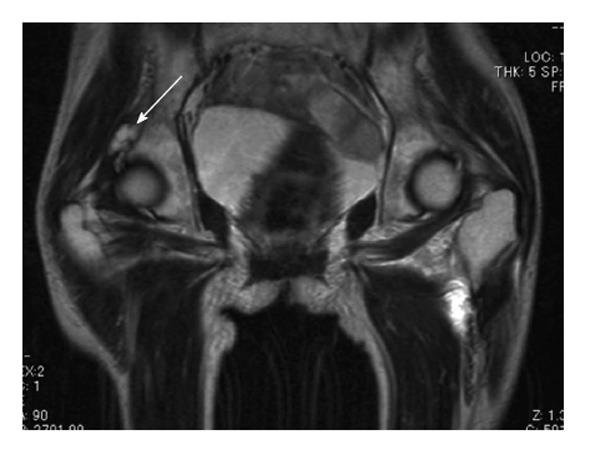 Cystic lesion around the hip joint