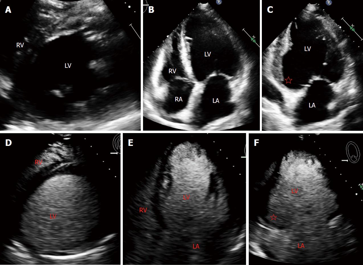 Elusive left ventricular thrombus: Diagnostic role of cardiac magnetic resonance imaging-A case ...