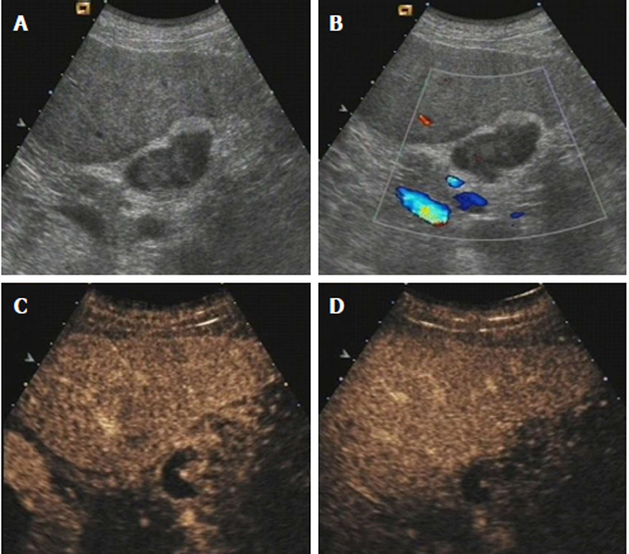 Value of contrast-enhanced ultrasound in the differential diagnosis of ...