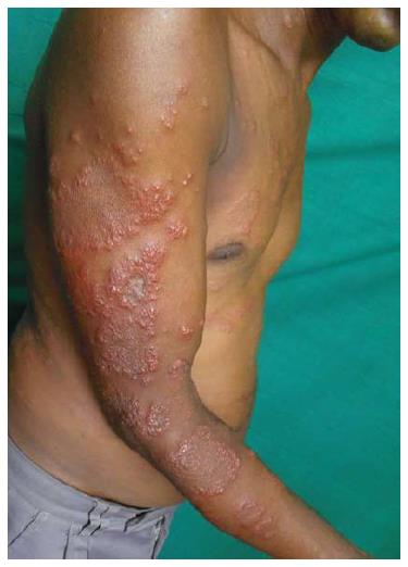 Clinical Variants Of Pityriasis Rosea