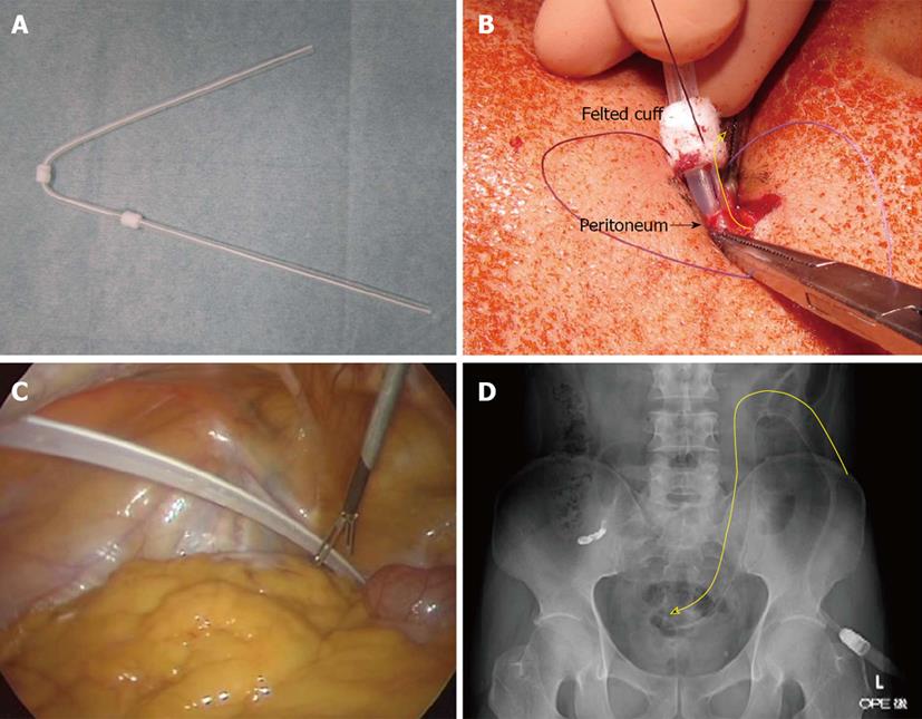 Gallery of Peritoneal Dialysis Surgery.