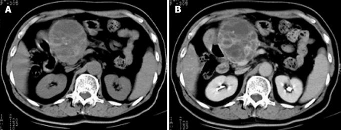 A case of primary malignant fibrous histiocytoma of the pancreas: CT ...