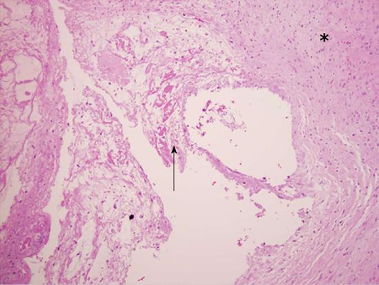 Arachnoid Cyst Histology