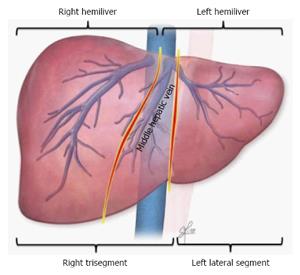 Split Liver Transplantation In Adults - 