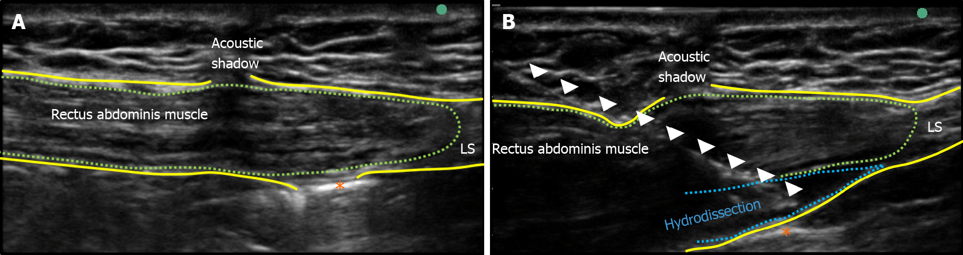 Ultrasound Guided Rectus Sheath Block For Anterior Cutaneous Nerve Entrapment Syndrome After