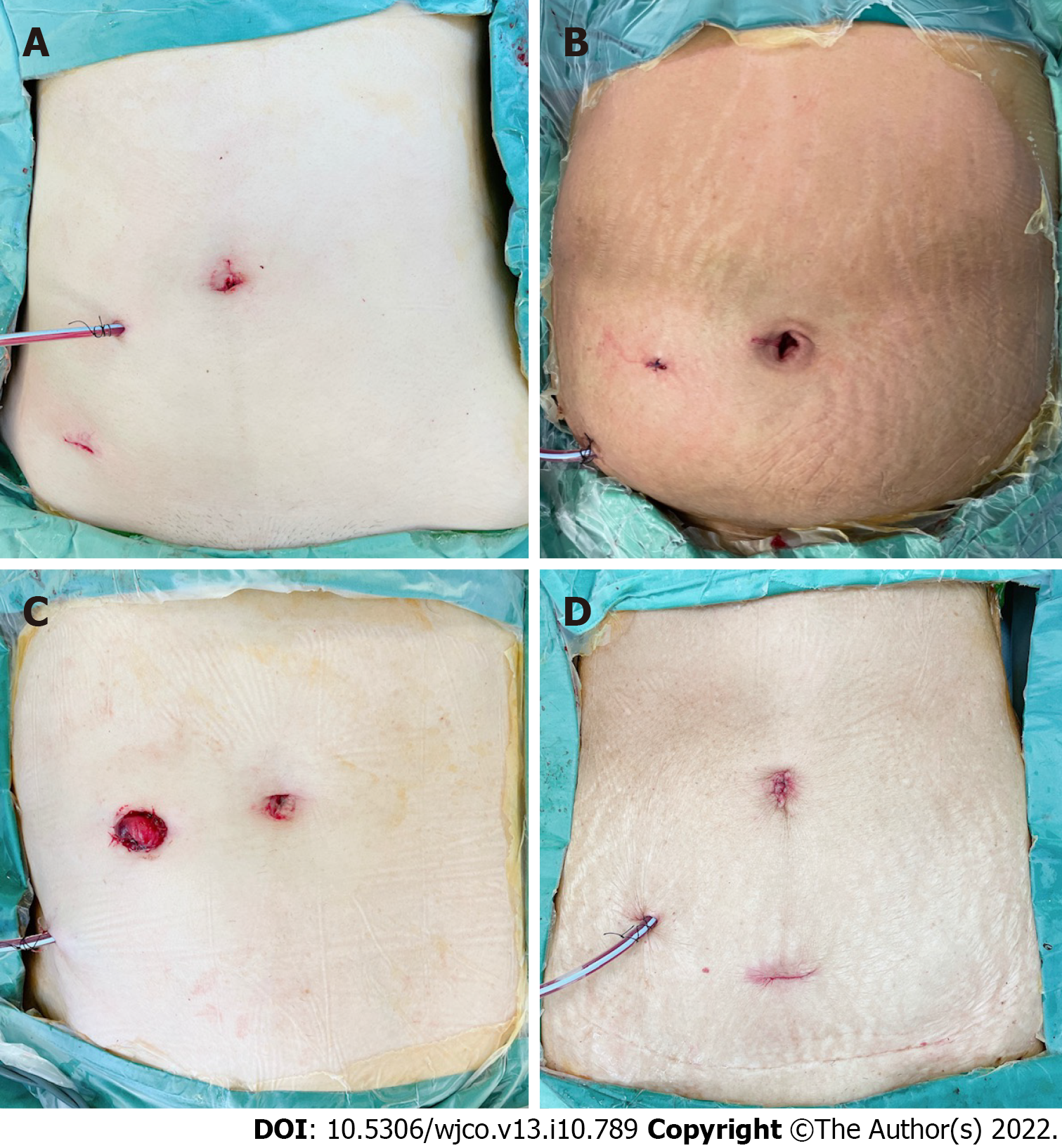 Undermining during cutaneous wound closure for wounds less than 3 cm in  diameter: a randomized split wound comparative effectiveness trial |  Archives of Dermatological Research