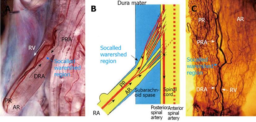 Spinal stenosis and neurogenic claudication - Lubbock, Amarillo