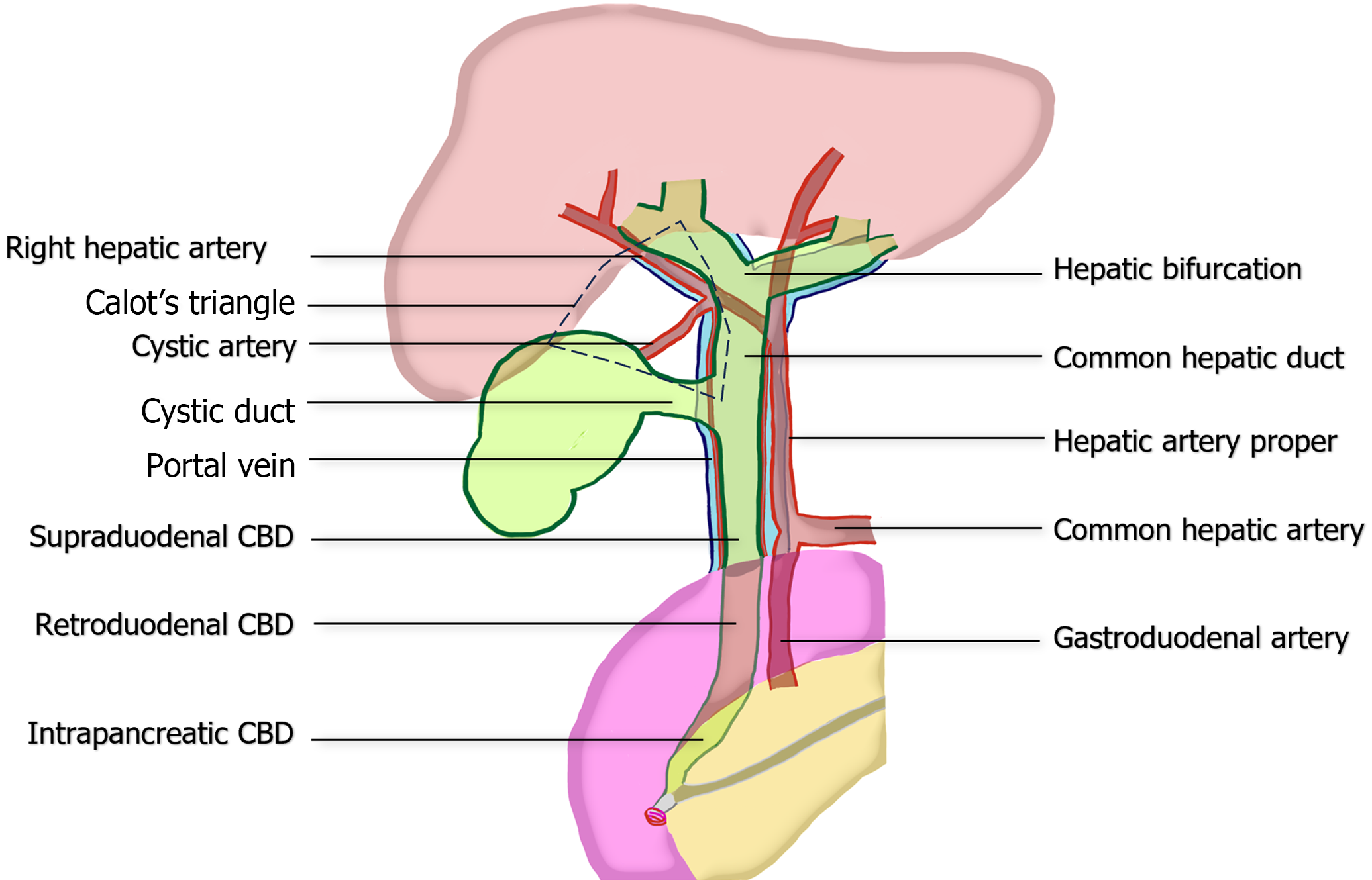 Surgical Strategies For Challenging Common Bile Duct Stones In The Surgical Strategies For Challenging Common Bile Duct Stones In The