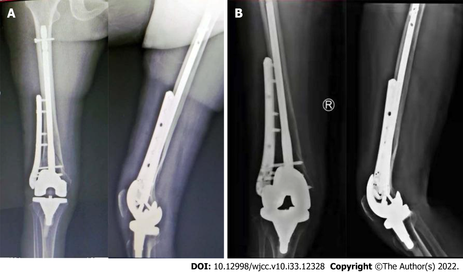 Periprosthetic Fracture Resembling Atypical Femoral Fracture After Fixation  With Retrograde Intramedullary Nail in Elderly Women: A Report of Two Cases  | In Vivo