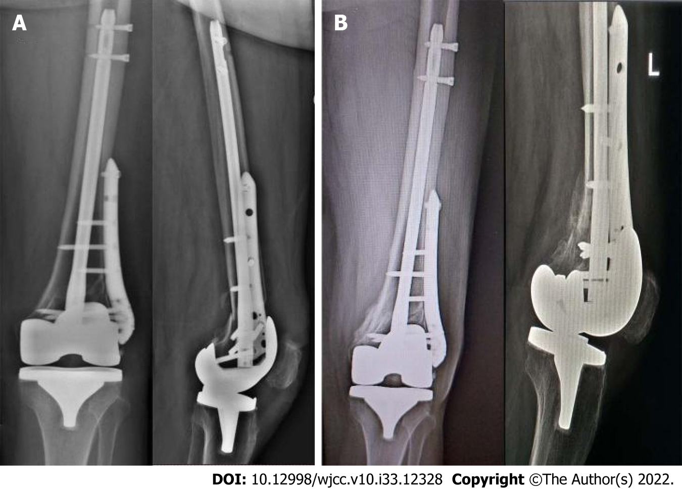 Accuracy and Safety of Distal Femoral Valgus Correction: A Comparison of  Three Techniques