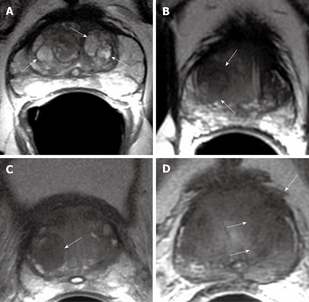 Multi parametric MR Imaging Of Transition Zone Prostate Cancer Imaging 