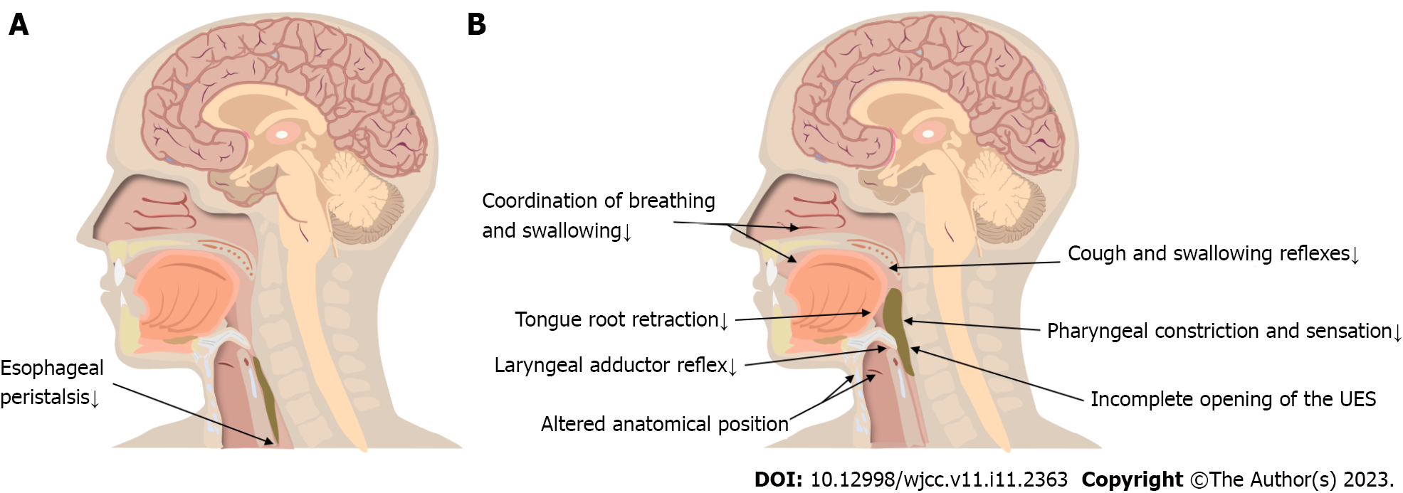 Normal Swallowing vs Aspiration - Trial Exhibits Inc.